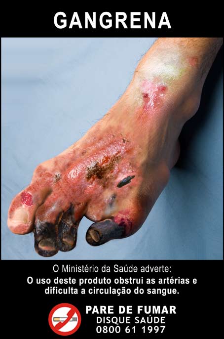 Brazil 2008 Health Effects vascular system - gangrene, gross, diseased foot